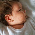 Neurodermitis bei Kindern homöopathisch behandeln