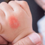 Insektenstiche natürlich behandeln: Die besten Globuli im Sommer Insektenstiche natürlich behandeln: Die besten Globuli im Sommer